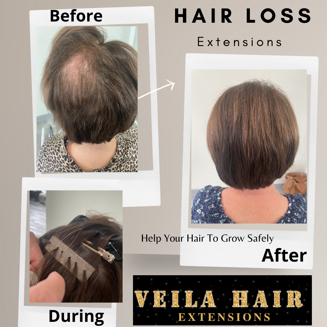 Tape in top hair extensions alopecia